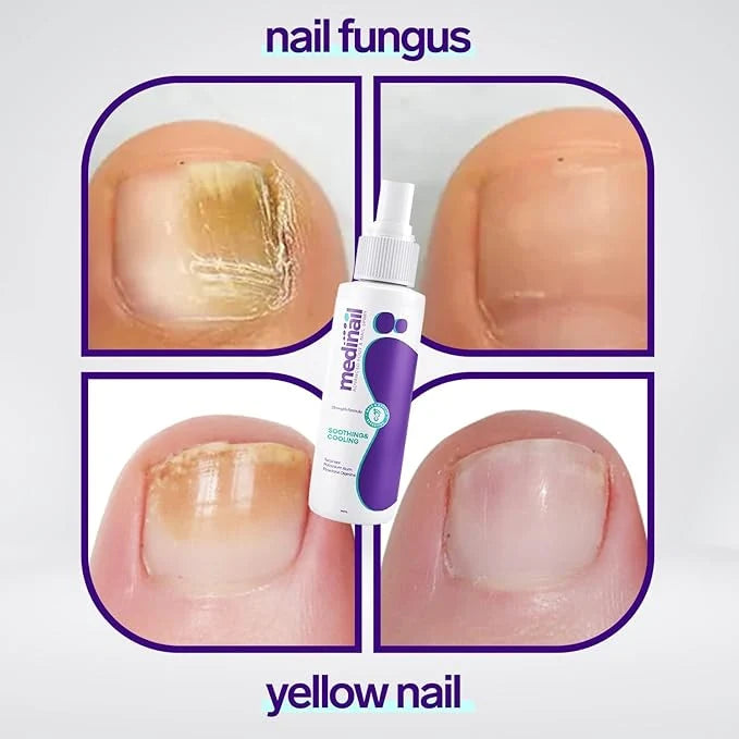 Jaysuin Nail Fungus Care Spray – 100ml