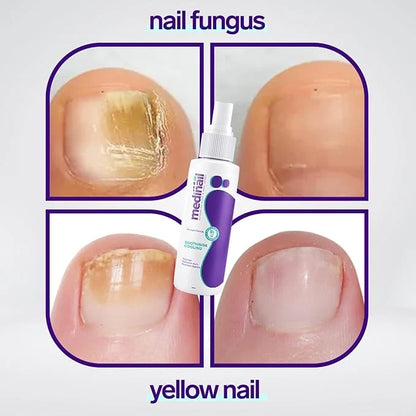 Jaysuin Nail Fungus Care Spray – 100ml